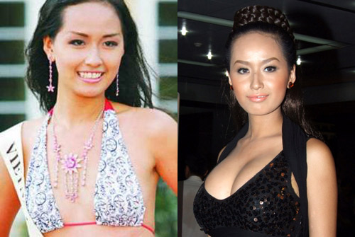 Nâng ngực thẩm mỹ Nâng ngực thẩm mỹ1