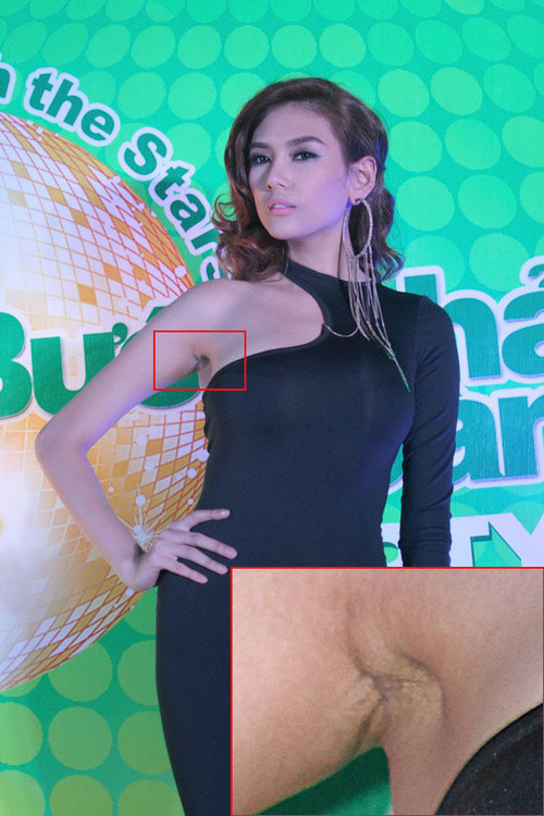 Nâng ngực thẩm mỹ Nâng ngực thẩm mỹ4