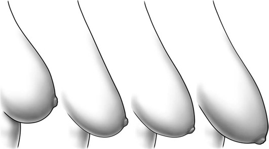 Phẫu thuật nâng ngực chảy xệ