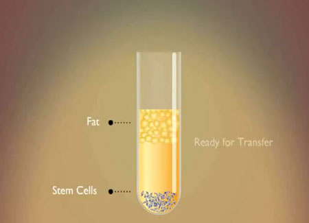 Nâng ngực bằng mỡ tự thân 1