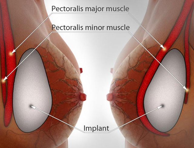 Nâng ngực nội soi dưới góc nhìn của chuyên gia 2