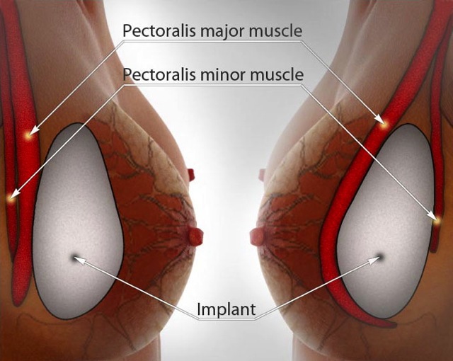 Bí quyết để sở hữu khuôn ngực đẹp “lý tưởng” 2