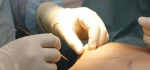 Thu nhỏ núm vú an toàn tại TMV Đông Á Thu nhỏ núm vú an toàn tại TMV Đông Á