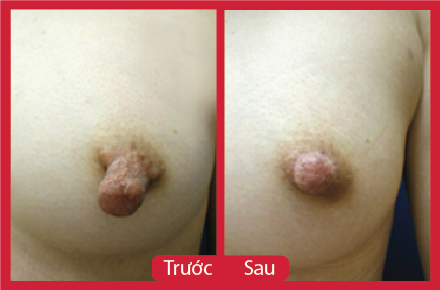 Thu nhỏ đầu ngực đẹp tự nhiên kết quả vĩnh viễn 4