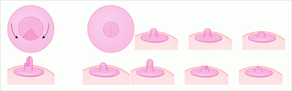 Kỹ thuật thu nhỏ núm vú an toàn, hiệu quả thu nhỏ núm vú an toàn