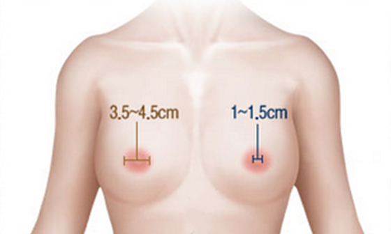 thu nhỏ núm vú an toàn