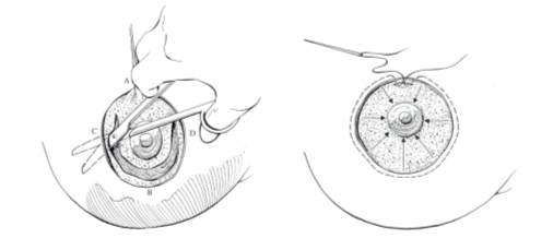 Giải phẫu thẩm mỹ nâng ngực chảy xệ
