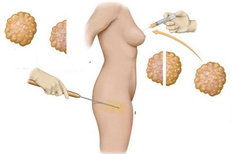 Giải phẫu thẩm mỹ nâng ngực bằng mỡ tự thân