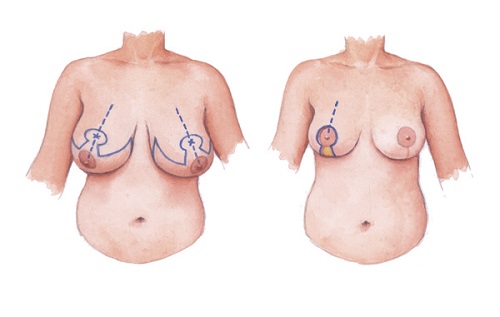 Mô phỏng đường cắt thu nhỏ vú phì đại thu-gon-nguc-phi-dai-1