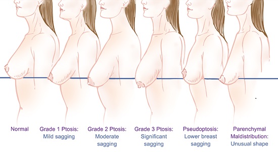 Ngực chảy xệ làm sao để khắc phục hiệu quả?