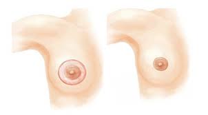 Thu nhỏ quầng vú và những ưu điểm vượt trội