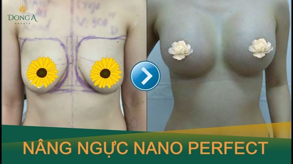 Tìm hiểu phương pháp nâng ngực Nano Perfect là gì?