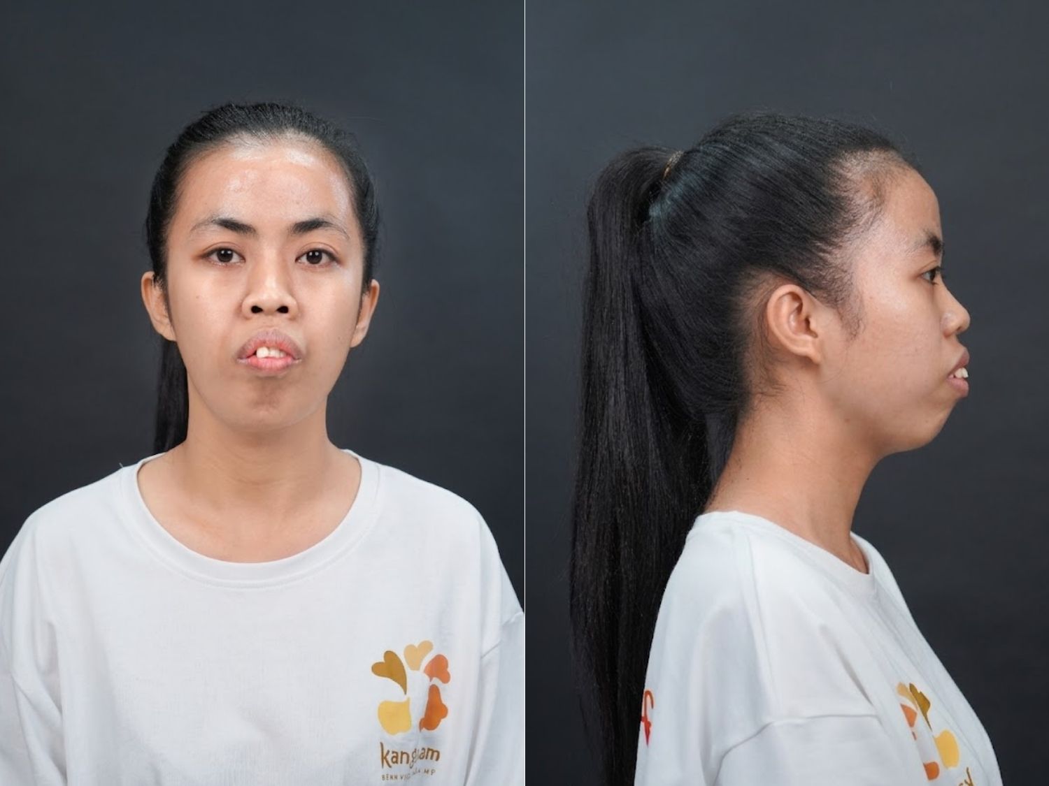 Dáng mũi và khuôn mặt trước phẫu thuật